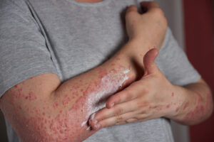Top 15 Remedies to Reverse Autoimmune Disease